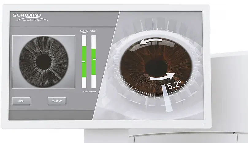 Hajataitto ja laserleikkaus? Koneellinen syklotorsion säätö tekee hajataiton hoidosta laserleikkauksella äärimmäisen tarkkaa.